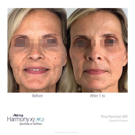 Laser Skin Resurfacing Treatments In Clearwater Fl The Refinery