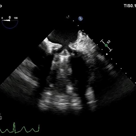 Pdf A Funnel Shaped Pannus Formation Above The Mitral Prosthetic