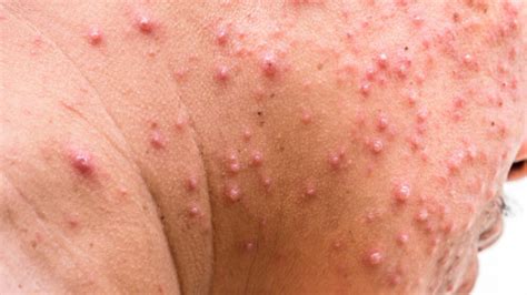 Herpes ist nur während der primärinfektion oder einer reaktivierung ansteckend. Die Gürtelrose am Kopf - Was tun gegen Herpes?