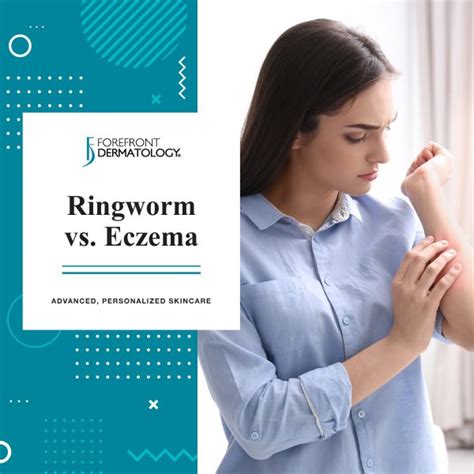 Ringworm Vs Eczema Forefront Dermatology