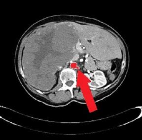 A Case Report Of Giant Hepatic Hemangioma Spontaneous Regression In