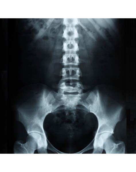 Radiografía De Columna Lumbosacra Coxis