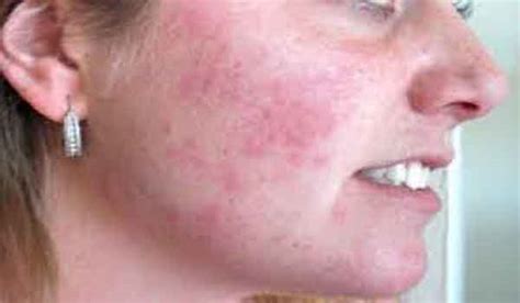 How To Get Rid Of Rashes On Summer Days