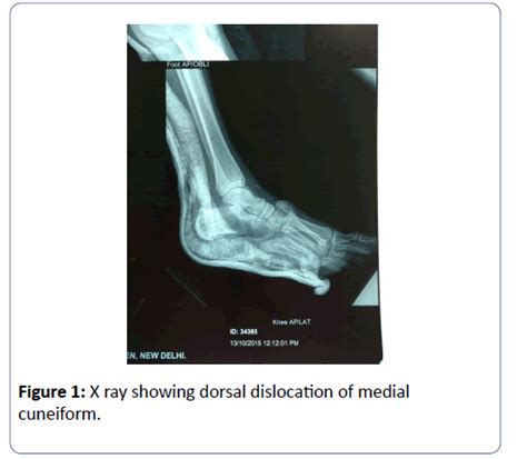 Dorsal Dislocation Of Medial Cuneiform Along With Lisfranc Injury