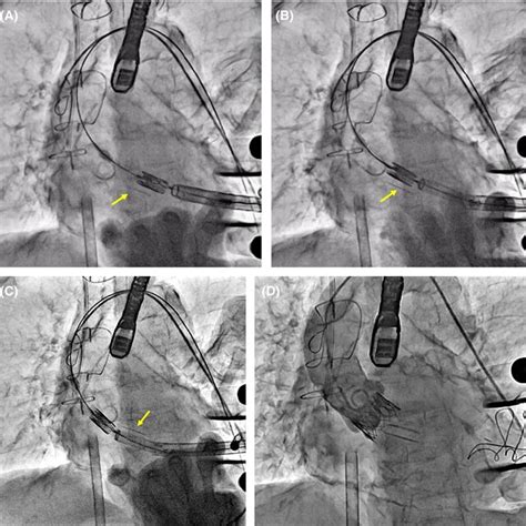 Intraoperative Picture Of A Starr Edwards Mitral Prosthesis Showing The