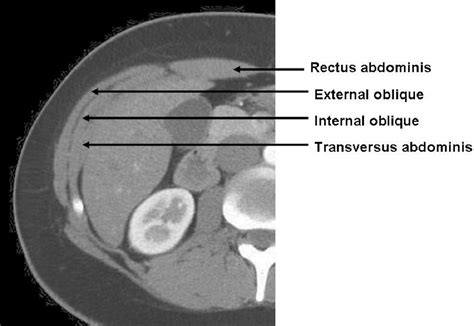 Imaging Of The Anterior Abdominal Wall A Radiological Review