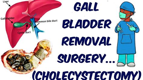 Actual Footage Gall Bladder Removal Surgery Cholecystectomy Youtube