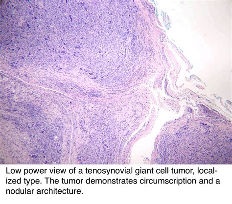 Pathology Outlines Tenosynovial Giant Cell Tumor Localized Type