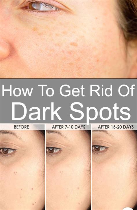 How To Get Rid Of Dark Spots Dark Spots On Face Spots On Face Best