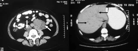 Abdominal Ct Scan Showing Two Masses White Arrows Beside Abdominal