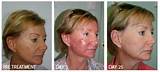 Images of Levulan Blue Light Treatment For Skin Cancer