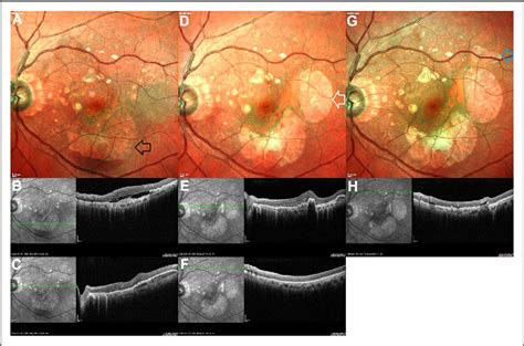 Figure 1 From Sequential Retinal Pigment Epithelium Tears Following