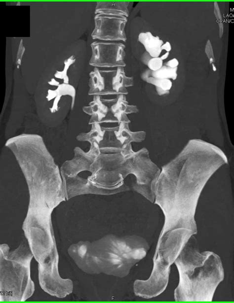 Ureteropelvic Junction Upj Obstruction Kidney Case Studies Ctisus