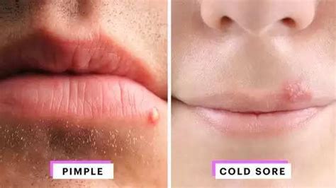 Dont Let Pimples Ruin Your Smile Top 5 Tips For Clearing Lip Blemishes
