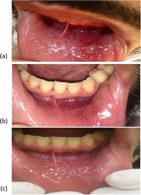 Photograph Of One Patient With Aphthous Ulcer Treated With The