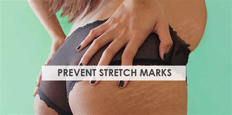 10 Tips For Preventing Stretch Marks During Pregnancy