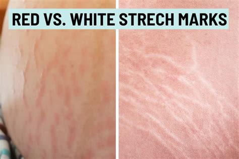 Red Stretch Marks Striae Rubra Causes And How To Treat Them