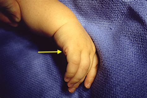 Polydactyly Hand Surgery Source