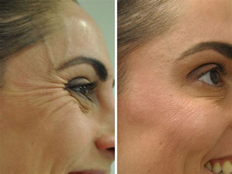 Botox Face Areas Before And After Where To Get Botox