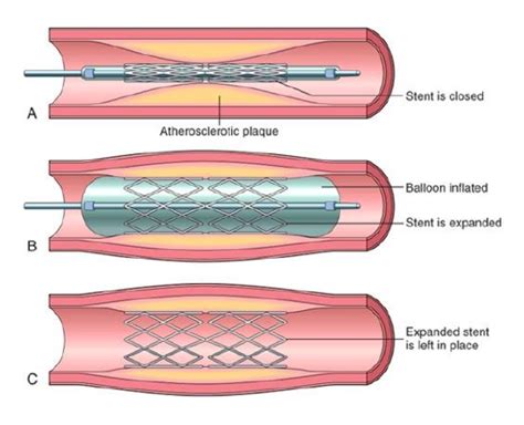 Angioplasty Pciptca Edmonton Cardiology Consultants