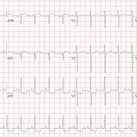 Initial Lead Electrocardiogram Showing Sinus Tachycardia Diffuse