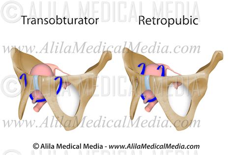 Mid Urethral Sling Transobturator Versus Retropubic Alila Medical Images