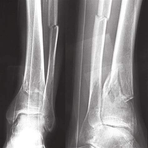 Fracture Of The Left Distal Tibia With Comminution Classifi Ed As 43