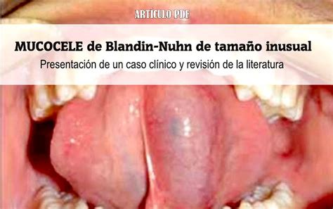 Pdf Mucocele De Blandin Nuhn De Tamaño Inusual Presentación De Un
