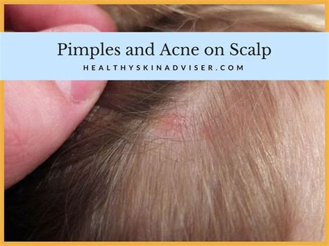 Remedies For Scalp Pimples Remedies Scalp Pimples On Scalp What