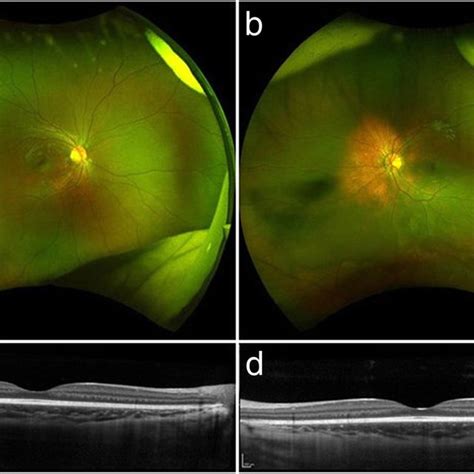 Ultra Widefield Color Fundus Photographs And Oct Images 1 Year After