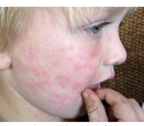 Figure 4 From Common Skin Rashes In Children Semantic Scholar