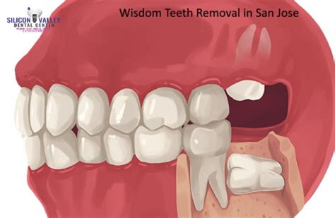 Wisdom Teeth Removal San Jose Cost Symptoms Recovery Oral Surgery Ca Silicon Valley