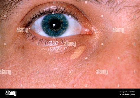 Xanthelasma A Yellow Swelling In The Skin Of The Lower Eyelid