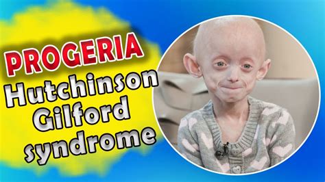 Genetic Disorder That Causes You To Grow Old Rapidly Progeria