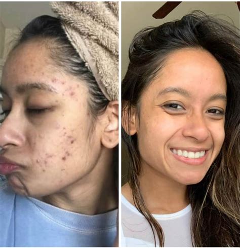 How Curology Cured My Hormonal Acne Curology Skincare Review 2022