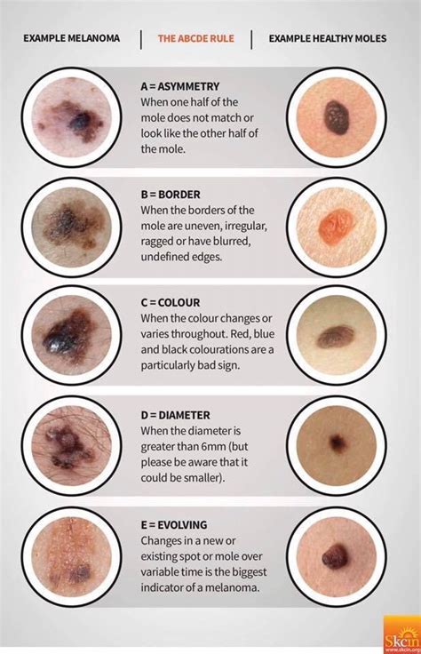So that's how we found out jim has skin cancer. Any fellow stage 4? : Melanoma