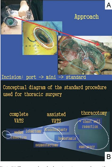 Figure 1 From The Blurred Border Between Thoracoscopic Surgery And