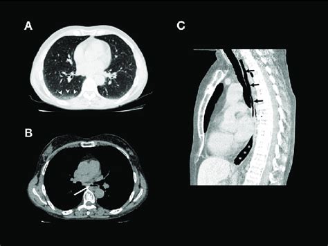 A Non Contrast Chest Ct Lung Window Shows Interlobular Septal
