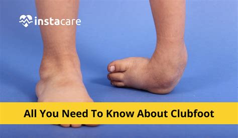 Everything You Need To Know About Clubfoot