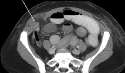 Herniated Loop Of Small Bowel Through Spigelian Fascia Open I