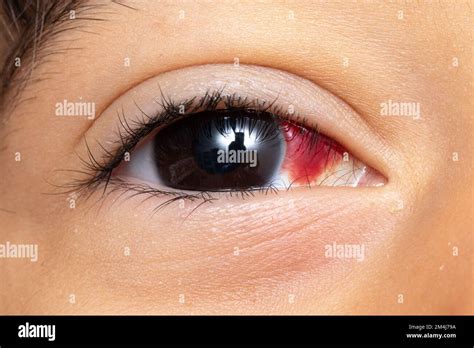 Macro Of Kid Eye With Subconjunctival Hemorrhage Blood Stain In The