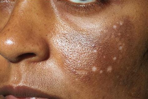Hyperpigmentation How To Properly Treat And Prevent It For Glowing Skin