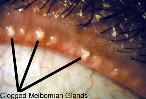 Meibomian Glands Clogged Meibomian Gland Disease Resized 600 Dr