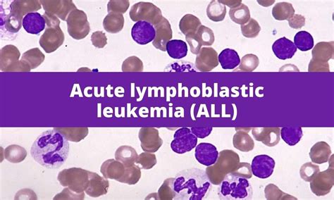 Acute Lymphoblastic Leukemia All Medical Junction