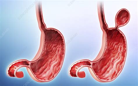 Human Stomach With Hernia Artwork Stock Image F0087246 Science