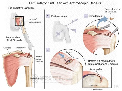 Left Rotator Cuff Tear With Arthroscopic Repairs Ami Cleveland 2015