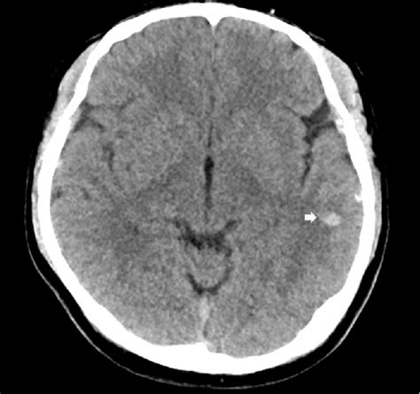 Contrast Enhanced Computed Tomography Of Brain Intracerebral Hematoma