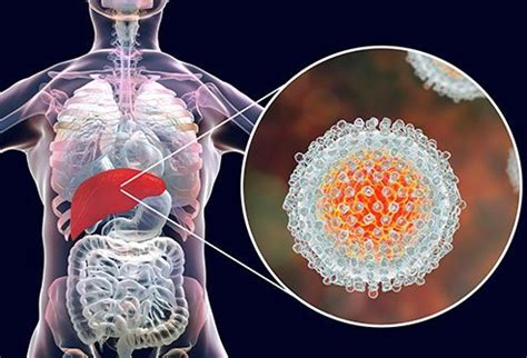 Siroz ve karaciğer hastalıkları başlı başına bir hepatit enfeksiyonunun son durağıdır. Is Hepatitis C Contagious? How Do You Get It?