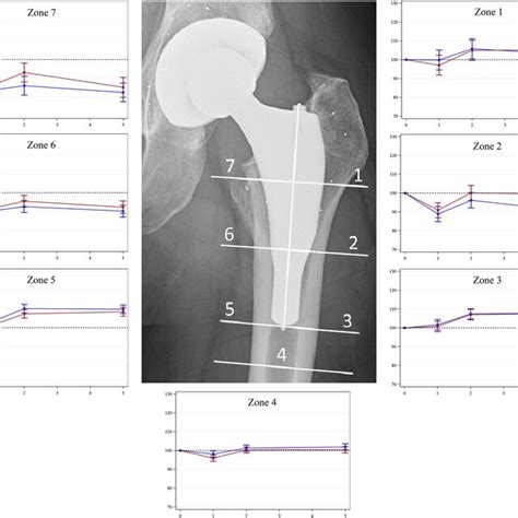 Radiograph Demonstrating The Seven Gruen Zones Graphs Represent The