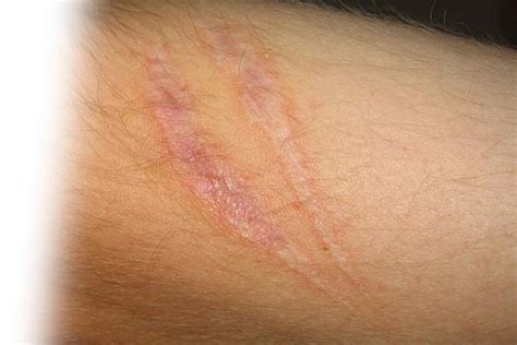 Skin Injury Claim Worth Dermatitis Compensation Scott Rees